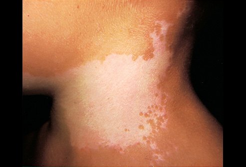 白癜风皮肤病有哪些常见种类呢?