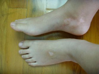 白癜风白斑扩散速度快吗?