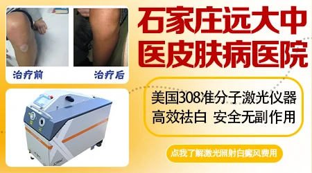 石家庄治白癜风的医生怎么选择