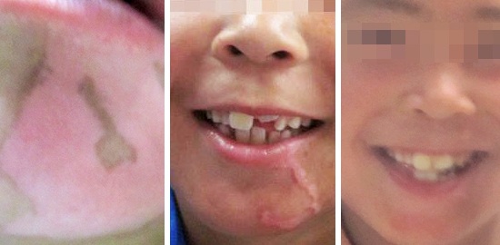 深度解析：青少年为何频陷白癜风危机!