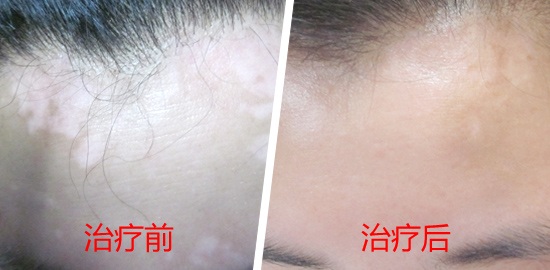 相约里约奥运会，白斑患者应该get到的几件事?
