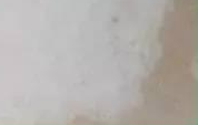 晚期白癜风的症状有哪些？
