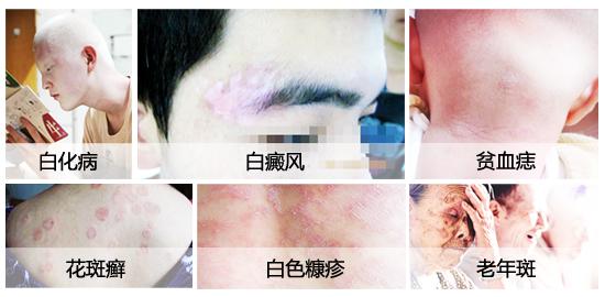 儿童背部有白点病怎么办