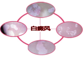 外伤型白癜风可以治疗吗