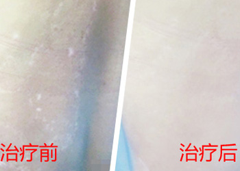 白癜风比较有效的疗法