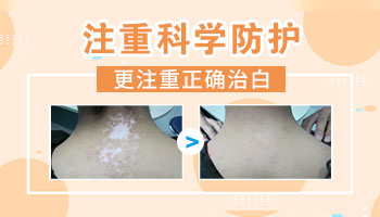 白癜风在治疗期间有哪些注意的事项呢?