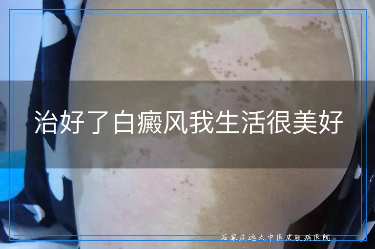 治好了白癜风我生活很美好