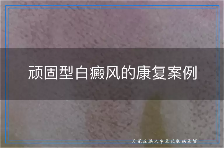 顽固型白癜风的康复案例