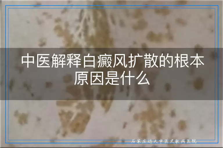 中医解释白癜风扩散的根本原因是什么