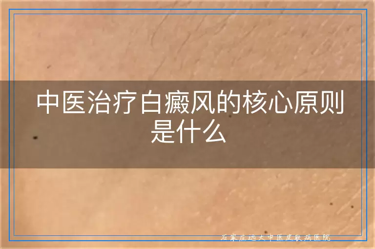 中医治疗白癜风的核心原则是什么