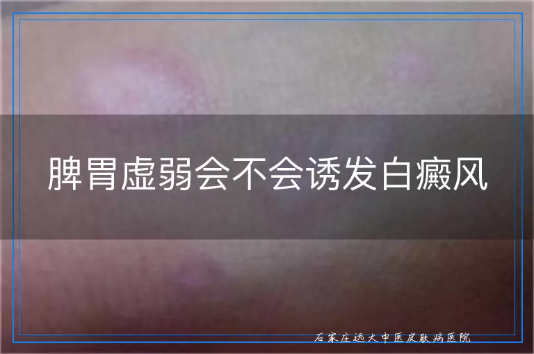 脾胃虚弱会不会诱发白癜风
