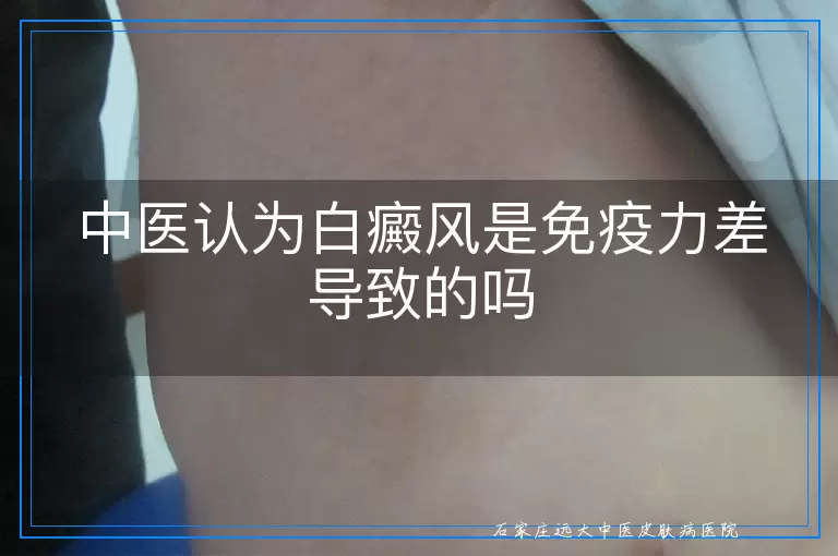 中医认为白癜风是免疫力差导致的吗