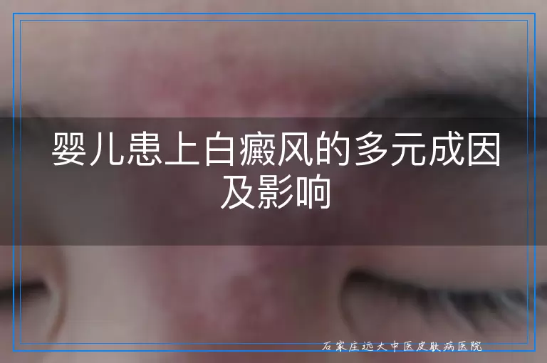 婴儿患上白癜风的多元成因及影响
