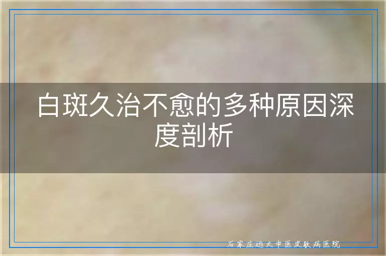 白斑久治不愈的多种原因深度剖析