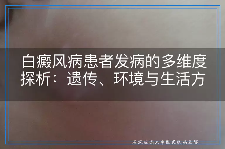 白癜风病患者发病的多维度探析：遗传、环境与生活方式的交织影响