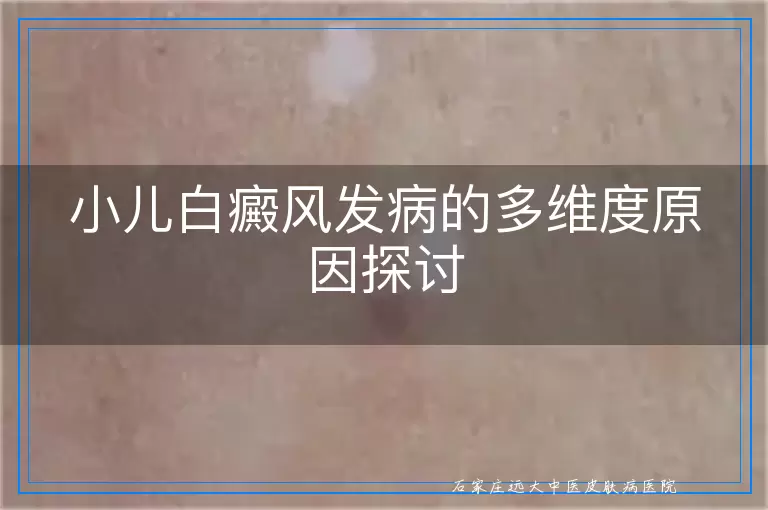 小儿白癜风发病的多维度原因探讨