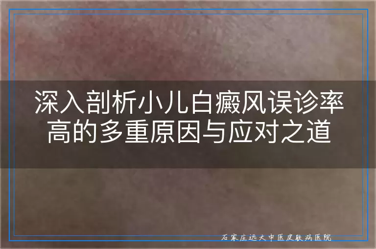 深入剖析小儿白癜风误诊率高的多重原因与应对之道