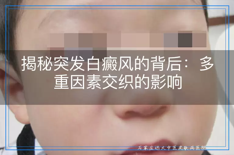 揭秘突发白癜风的背后：多重因素交织的影响