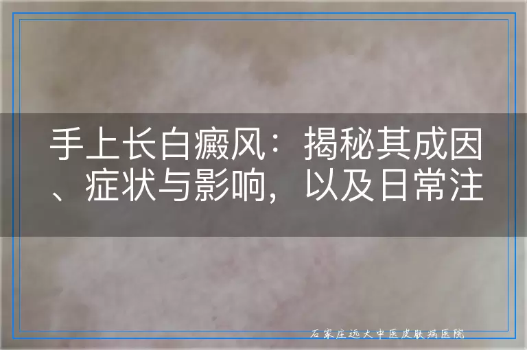 手上长白癜风：揭秘其成因、症状与影响，以及日常注意事项