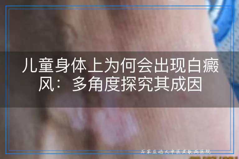 儿童身体上为何会出现白癜风：多角度探究其成因