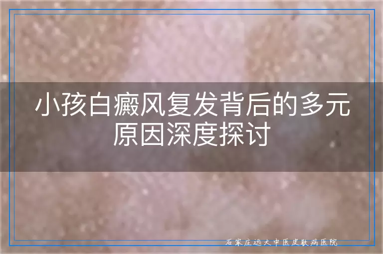 小孩白癜风复发背后的多元原因深度探讨