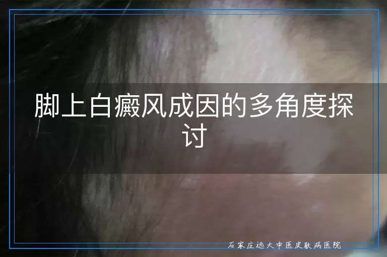 脚上白癜风成因的多角度探讨
