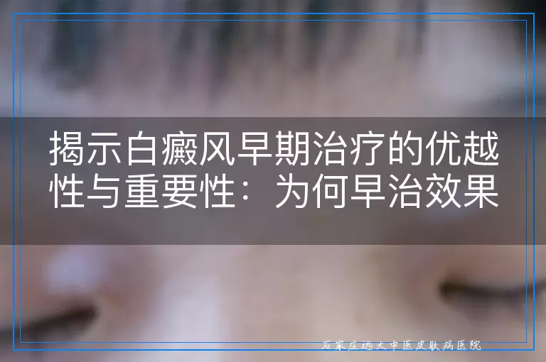 揭示白癜风早期治疗的优越性与重要性：为何早治效果更佳