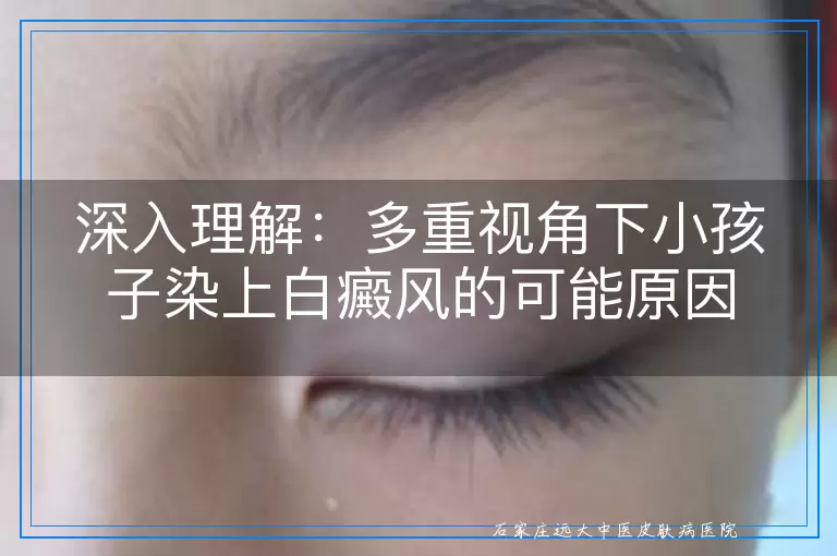 深入理解：多重视角下小孩子染上白癜风的可能原因