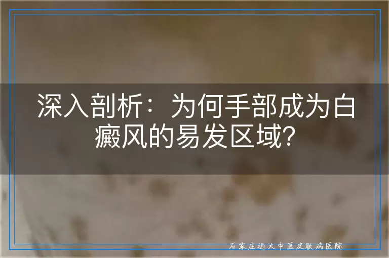 深入剖析：为何手部成为白癜风的易发区域？