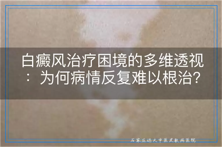白癜风治疗困境的多维透视：为何病情反复难以根治？