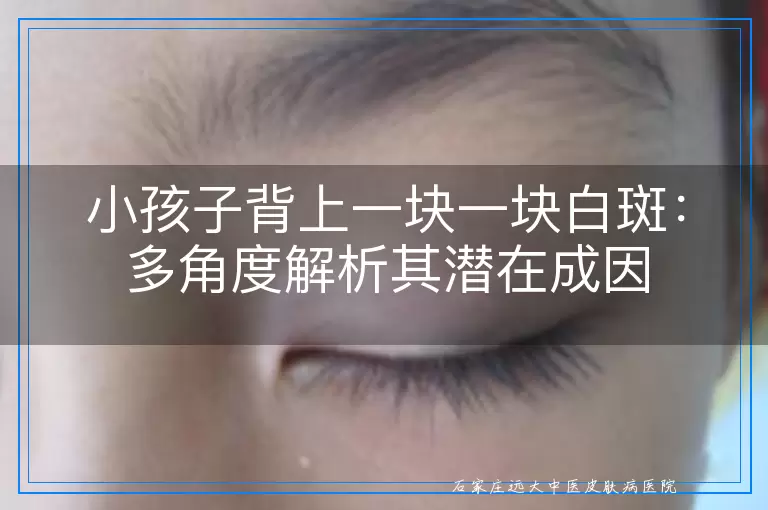 小孩子背上一块一块白斑：多角度解析其潜在成因