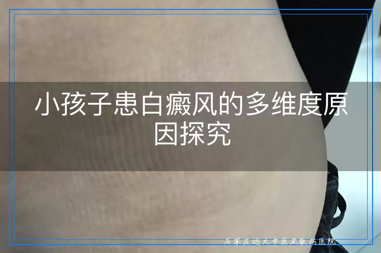 小孩子患白癜风的多维度原因探究