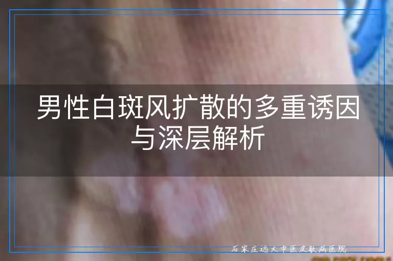 男性白斑风扩散的多重诱因与深层解析