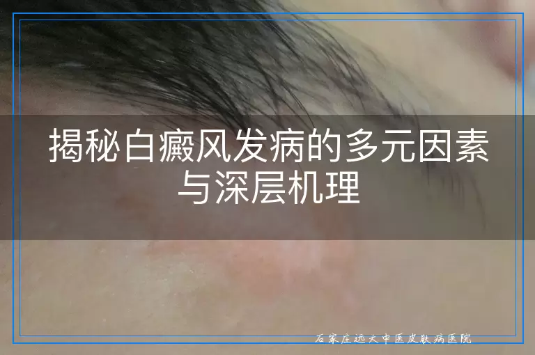 揭秘白癜风发病的多元因素与深层机理