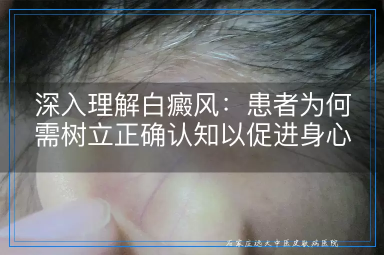 深入理解白癜风：患者为何需树立正确认知以促进身心健康