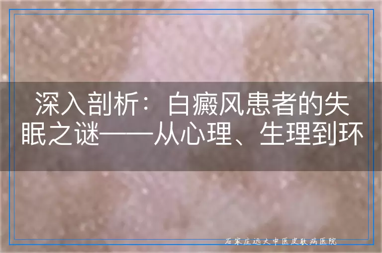 深入剖析：白癜风患者的失眠之谜——从心理、生理到环境的多维度探讨