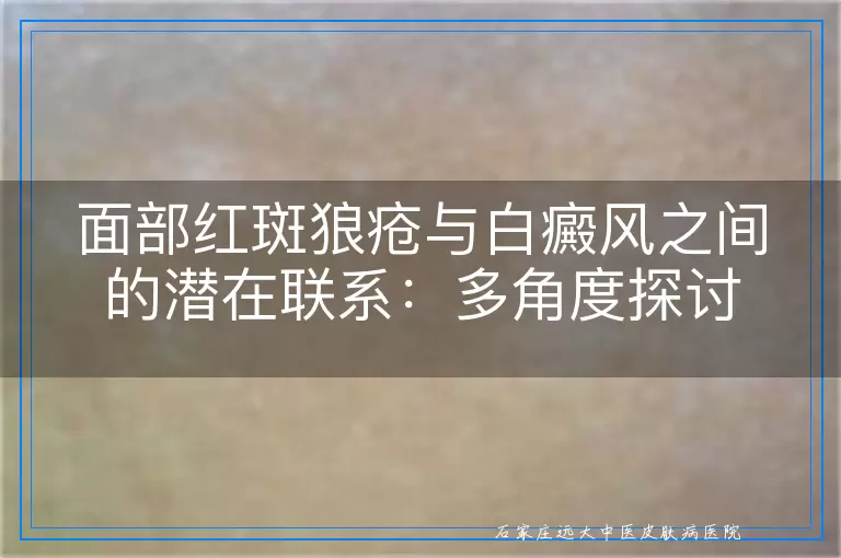 面部红斑狼疮与白癜风之间的潜在联系：多角度探讨