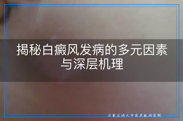 揭秘白癜风发病的多元因素与深层机理