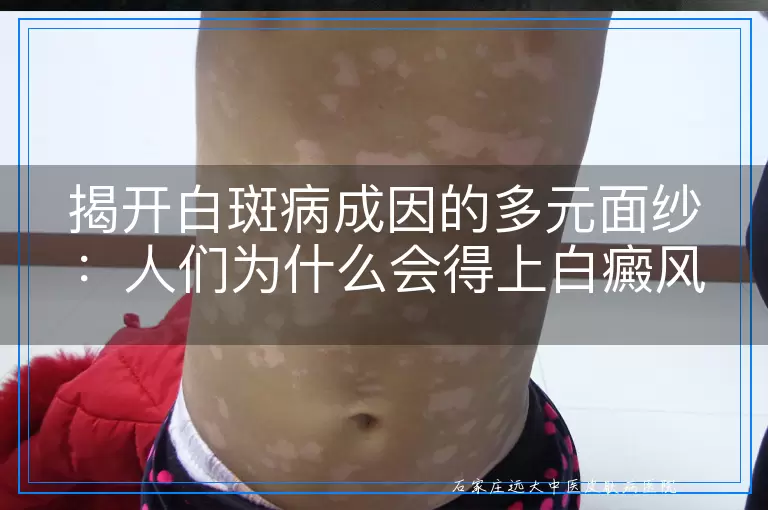 揭开白斑病成因的多元面纱：人们为什么会得上白癜风