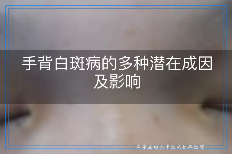手背白斑病的多种潜在成因及影响