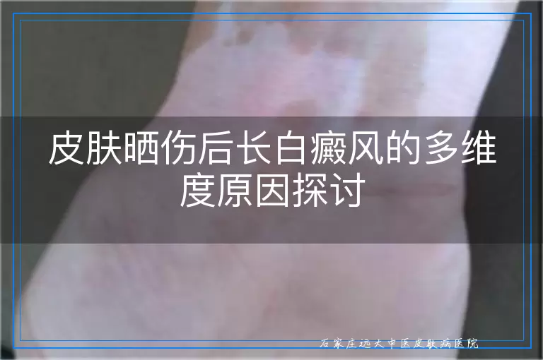 皮肤晒伤后长白癜风的多维度原因探讨