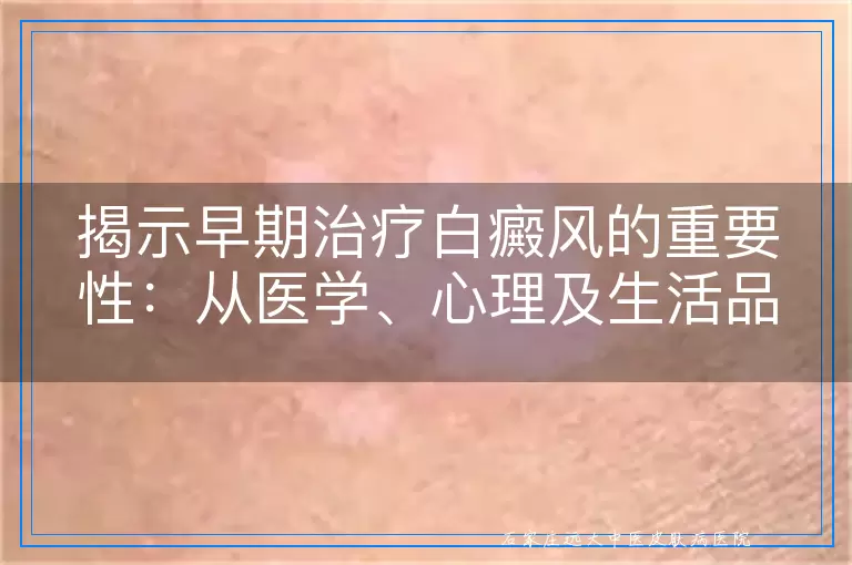 揭示早期治疗白癜风的重要性：从医学、心理及生活品质多维度探讨