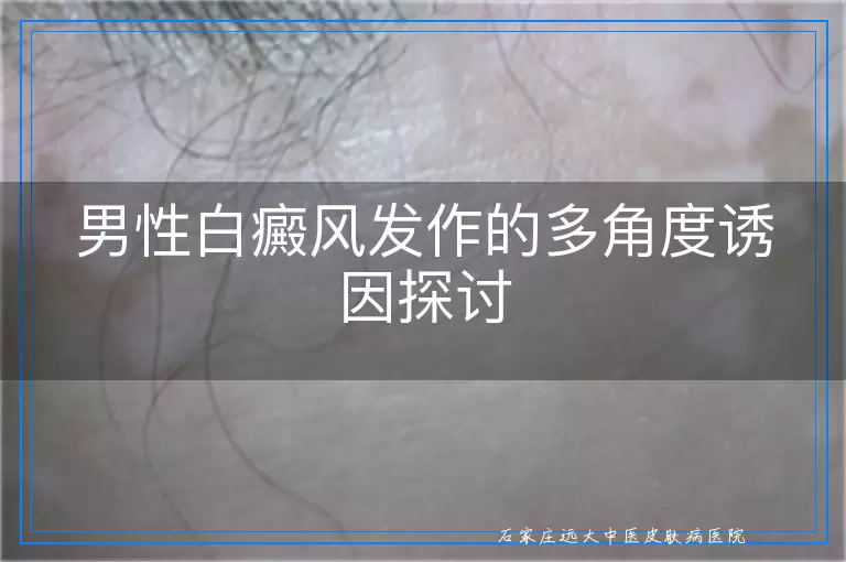 男性白癜风发作的多角度诱因探讨