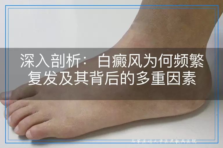 深入剖析：白癜风为何频繁复发及其背后的多重因素