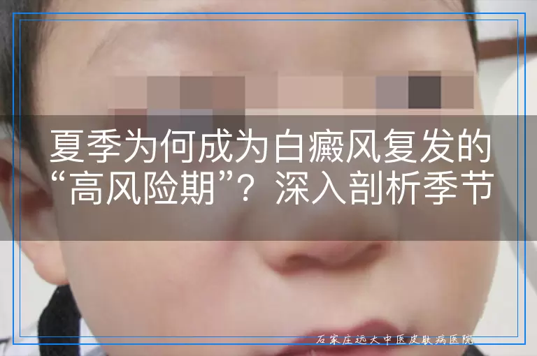 夏季为何成为白癜风复发的“高风险期”？深入剖析季节变换对白癜风病情的影响