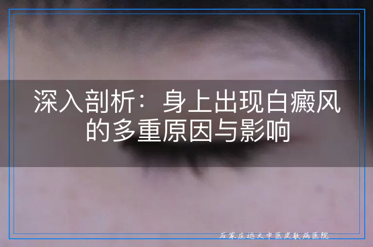 深入剖析：身上出现白癜风的多重原因与影响