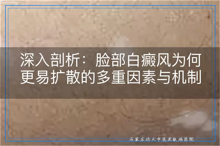 深入剖析：脸部白癜风为何更易扩散的多重因素与机制