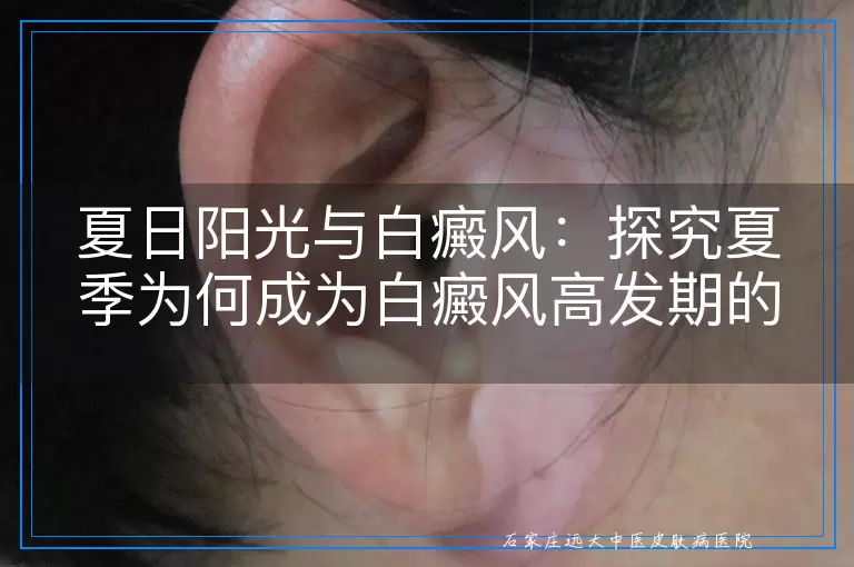 夏日阳光与白癜风：探究夏季为何成为白癜风高发期的多重因素