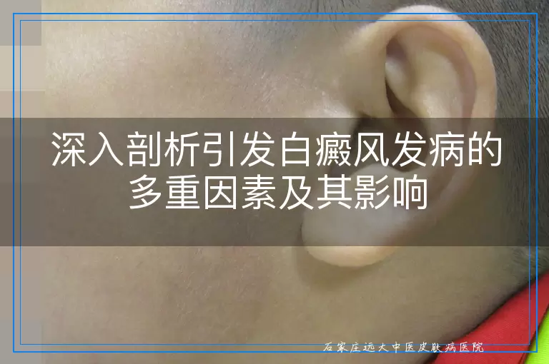 深入剖析引发白癜风发病的多重因素及其影响