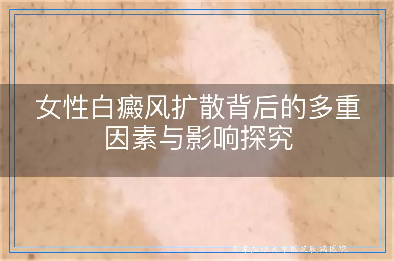 女性白癜风扩散背后的多重因素与影响探究